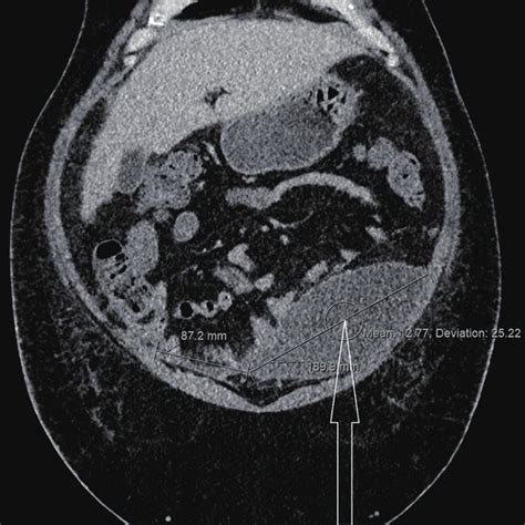 Computed Tomography Ct Scan Of The Abdomen Demonstrating A Large