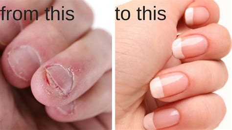 Top 124 How To Stop Biting Nails And Picking Skin Architectures