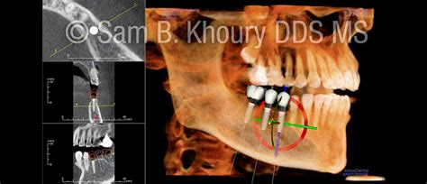 Dental Ct Scan Cbct Dr Sam Khoury