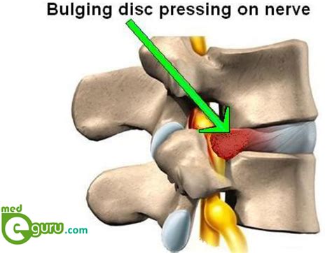 How Bulging Disc Is Caused Treatments For Bulging Discsmed E Guru