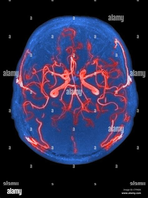 Cerebral Angiogram Hi Res Stock Photography And Images Alamy