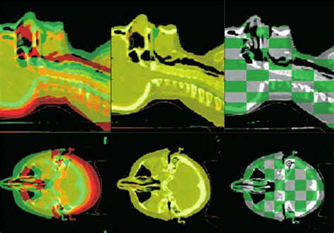 Deformable Image Registration Of Head And Neck Computed Tomography