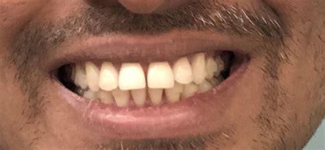 9 use the shim stock in between and across the two arches in order to establish teeth that are naturally occluding and naturally discluding. Trying to fix 6mm overjet with Invisalign, I've got 54 ...