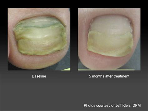 Pre And Post Treatment Pictures Cutera St Catharines Ontario Canadian