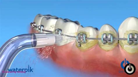 Maybe you would like to learn more about one of these? Waterpik with braces - YouTube