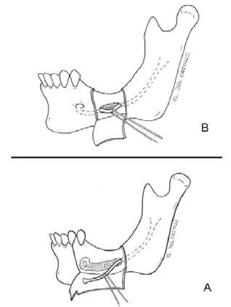 A Schematic Representation Of Alveolar Nerve Lateralization An