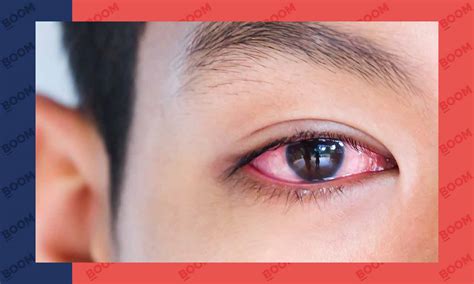 Rising Conjunctivitis Cases In India Causes And Precautions Explained