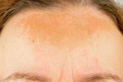 What Is Melasma Chloasma And How Can You Remove It