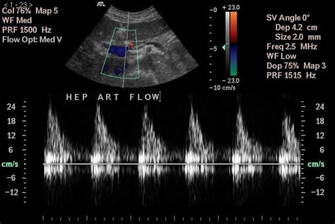 1 Colour Doppler Duplex Ultrasound Of Common Hepatic Artery