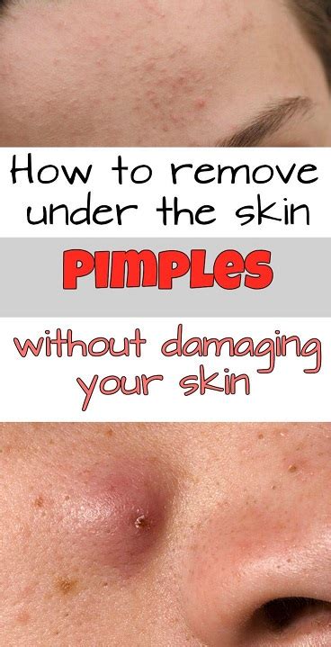 A good way to get rid of blackheads fast is by using a pore stripper. 10 WAYS TO GET RID OF UNDER SKIN PIMPLES FAST - Style Vast