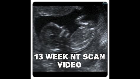 12 13 Week Nt Scan Ultrasound Video Youtube