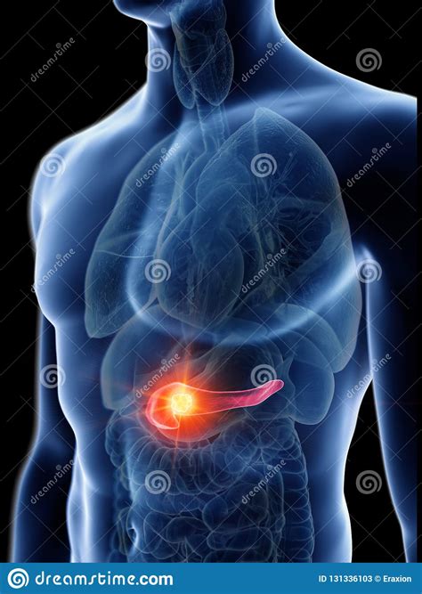 A Mans Pancreas Tumor Stock Illustration Illustration Of Insulin