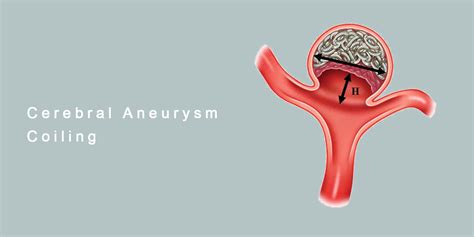 Endovascular Treatment For Cerebral Aneurysms