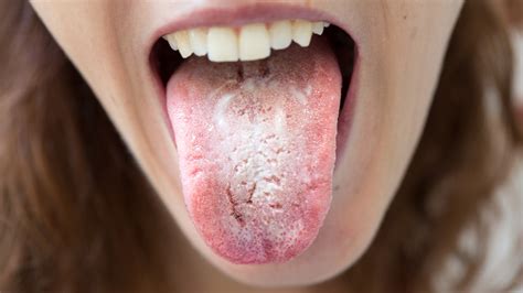 What Does It Really Mean When Your Tongue Is White