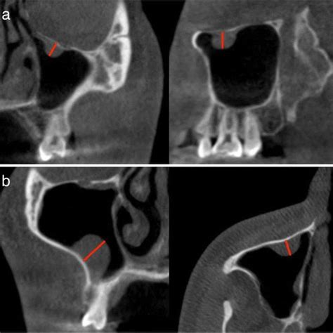 Cbct Image Of A Patient With A Mucous Retention Cyst That Was Diagnosed Download Scientific