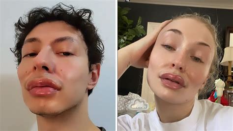 Gelehrte Gleich Verlassen Dicke Lippen Filter Instagram Finden Beweis Forensische Medizin