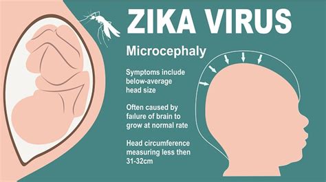Guidelines And Faq For Pregnant Women On Zika And Pregnancy By Moh Advisory Group