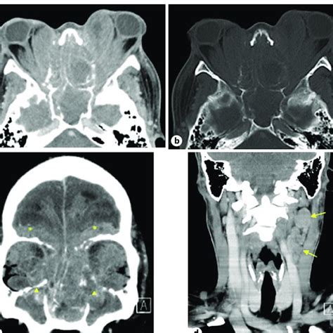 Axial Contrast Enhanced Computed Tomography Scan In Soft Tissue A And