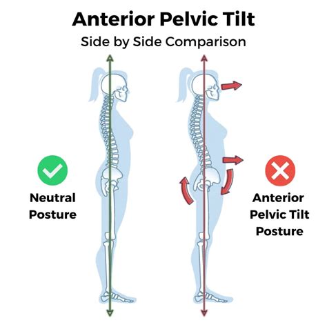 Anterior Tilt Causing Pain Try These Anterior Pelvic Tilt Tests