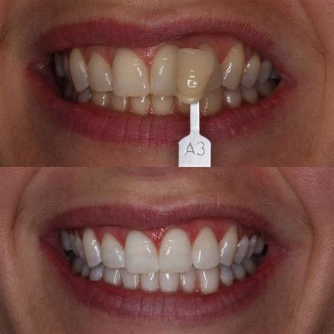 Zoom Teeth Whitening To Get Your Teeth And Smile To Their Whitest White
