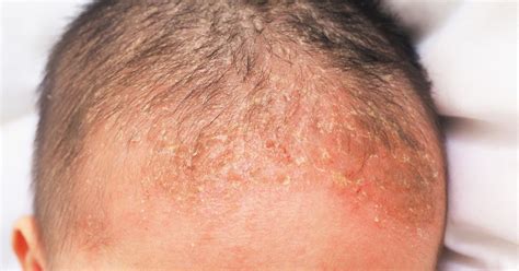 Frequently Asked Questions About Cradle Cap Facty Health