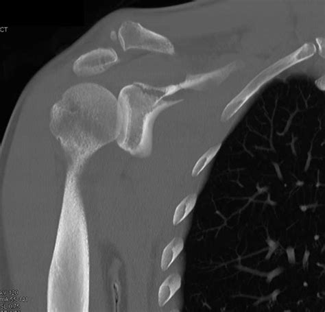 Glenoid Fracture And Widening Of The Ac Joint Musculoskeletal Case