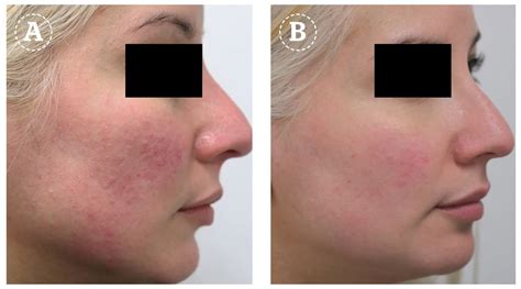 The Uses Of Long Pulsed Ndyag Laser In Dermatology Prime Journal