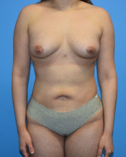 Patient Liposuction Before And After Photos Houston Plastic Surgery Gallery Katy TX