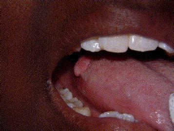 Hpv Lesion On Tongue