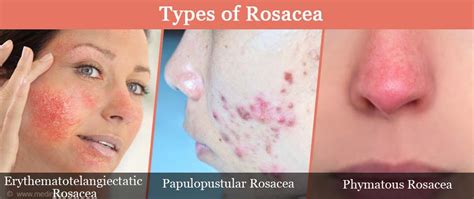 Maybe you would like to learn more about one of these? Rosacea: What You Need To Know About That Redness & Flushing On Your Face: Pine Belt Dermatology ...