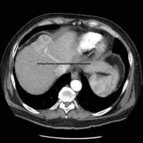 Triple Phase Ct Liver Revolutionizing Diagnostic Imaging