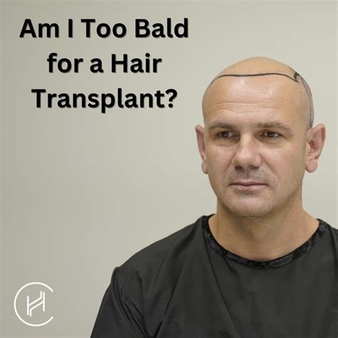 32 Completely Bald Hair Transplant Miltonharini