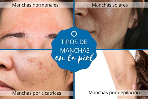 Tipos De Manchas En La Piel Y Cómo Tratarlas ¡con Fotos