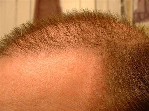 If you are having a large amount of the second option takes a lot more time, but avoids leaving a long, narrow scar on your scalp. Hair Transplant Results After 2 Months