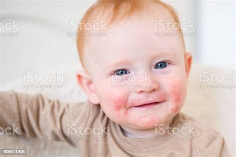 Boy With Atopic Dermatitis Stock Photo Download Image Now Atopic
