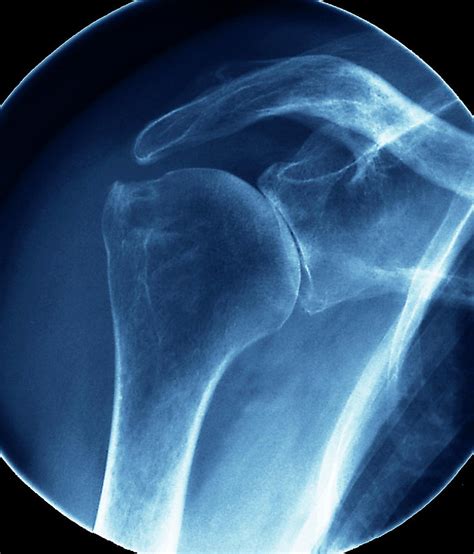 Arthritic Shoulder Photograph By Zephyr Science Photo Library Fine