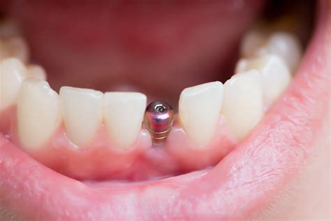 Benefits Of Single Tooth Dental Implants Bc Perio Dental Health