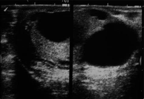 Поликистоз яичник диета Поликистоз яичников? Лечение возможно! Поликистоз яичников? Лечение возможно! Поликистоз яичник диета