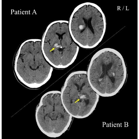 Computed Tomography Scans Show The Lesion Sites Of Patients A And B