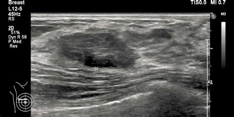 Taking Ultrasound Beyond Breast Density The Imaging Wire