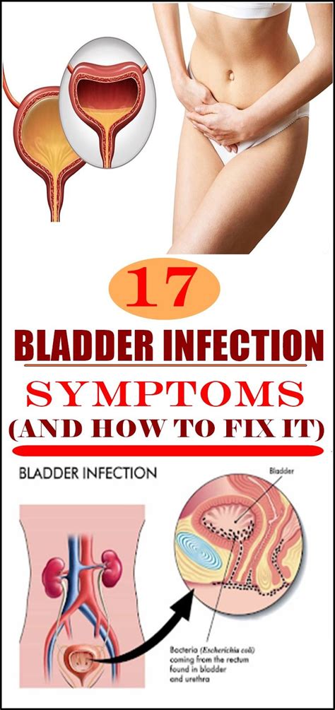 17 bladder infection symptoms and how to fix it cure bladder infection bladder infection