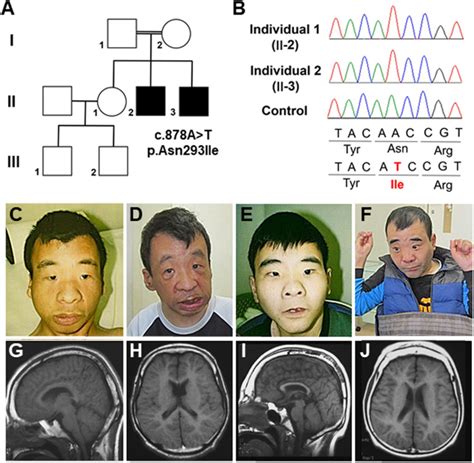 OTUD5 Variants Associated With X Linked Intellectual Disability And