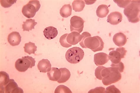 malaria y plasmodium imagenes del plasmodium falciparum y plasmodium vivax sexiz pix
