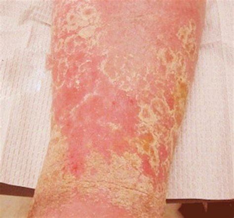 Stasis Dermatitis Pictures Symptoms Causes Treatment Diagnosis HubPages