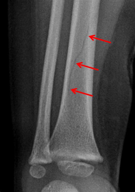 Toddler S Fracture