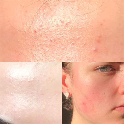 Skin Concerns Routine Help I Have These Ccs Or Fungal Acne Bumps