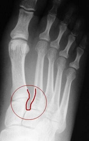 CalexFit, Foot Pain Relief Center - Conditions - Lisfranc ...