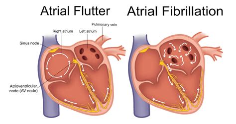 Atrial Flutter Vs Afib What S The Difference Wellue