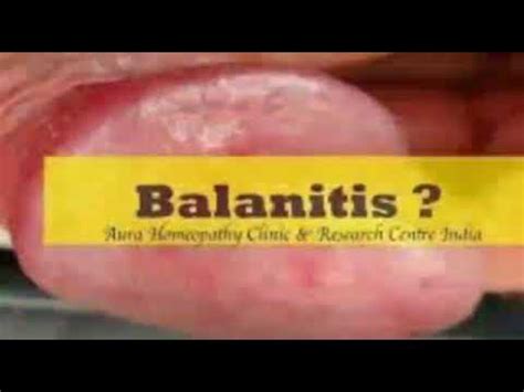 Balanitis Know About Phlf Youtube
