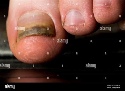 Toe Nail Injury Lifted Toe Nail Bed Close Up Thickened Nail Growth Due